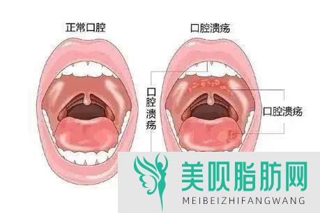 玻尿酸丰唇不适合哪些人,玻尿酸丰唇后注意事项