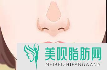 玻尿酸填充鼻唇沟有用吗,玻尿酸丰鼻唇沟术后护理