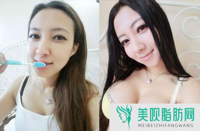 不同分子大小玻尿酸用途的区别,伊婉v型玻尿酸的特点