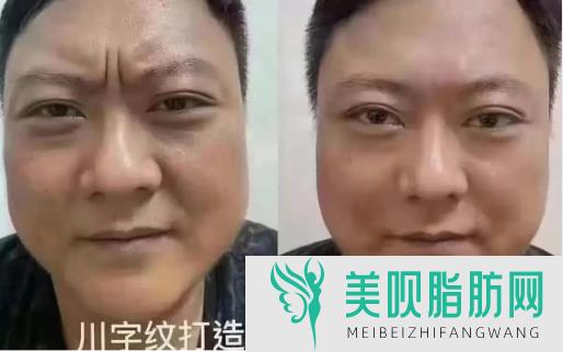 不同眼睛适合的美瞳线形状推荐,哪些人不适合做美瞳线