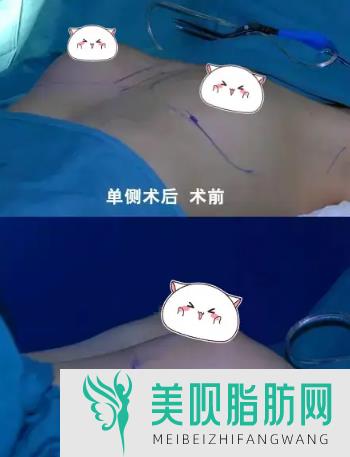 哺乳期隆胸怎么回事,什么时候隆胸好