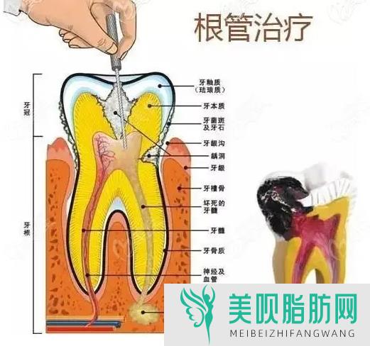 补牙后要注意什么,补牙后为什么会疼