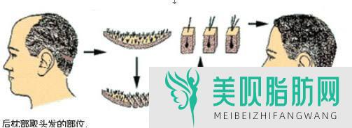 大神来谈谈常州发际线调整果好吗