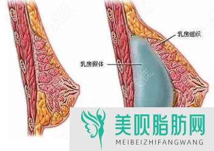 关于说说重庆自体脂肪丰胸果好吗，重庆哪里自体丰胸好