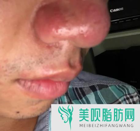 过来人今天说说万州华美腰腹部吸脂多少钱,万州抽脂多少钱