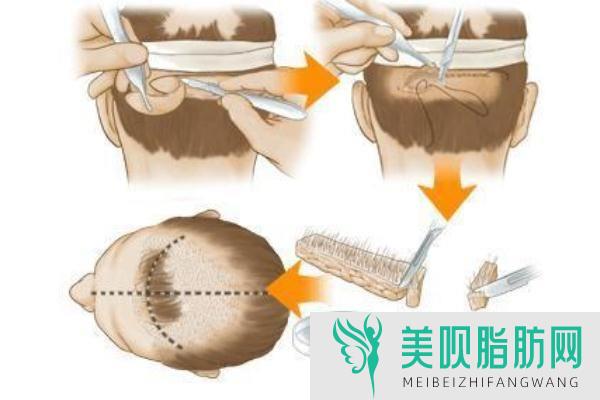 今日解说泉州头发种植费用,泉州哪里有种植头发