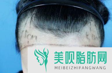 西安科发源植发医疗美容诊所2022植发项目价格