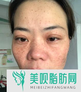 面部吸脂果如何(面部吸脂果如何)