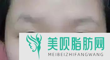 「今日爆」武汉协和杨杰做双眼皮怎么样,武汉协和杨杰双眼皮二次修复怎么样