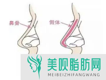 韩国垫鼻子多少钱,韩国硅胶垫下巴多少钱